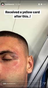 德米拉尔晒眉骨缝针照表达不满:被肘击之后我被出示了一张黄牌!